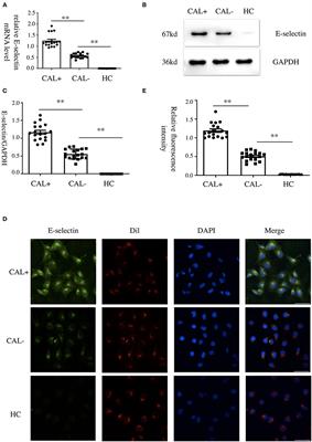 Oxidative Phosphorylation-Mediated E-Selectin Upregulation Is Associated With Endothelia–Monocyte Adhesion in Human Coronary Artery Endothelial Cells Treated With Sera From Patients With Kawasaki Disease